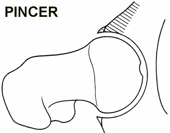 2d diagram of pincer lesion