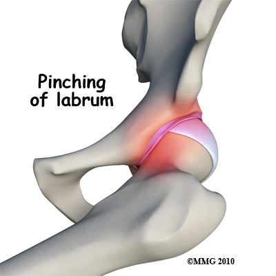 Pinching of the labrum